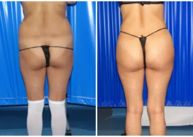 BBL fat transfer before after centre for surgery london