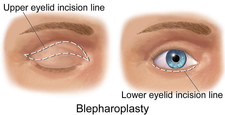blepharoplasty incisions