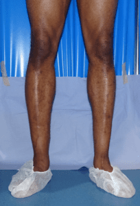 Calf Implants - Calf Augmentation London - Centre For Surgery