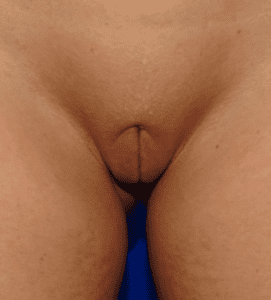 unilateral labiaplasty after