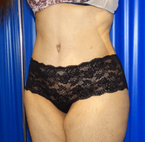 lipo and tummy tuck after