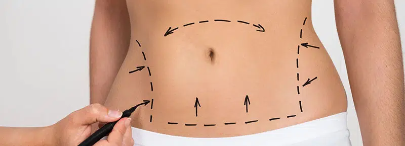 tummy tuck results