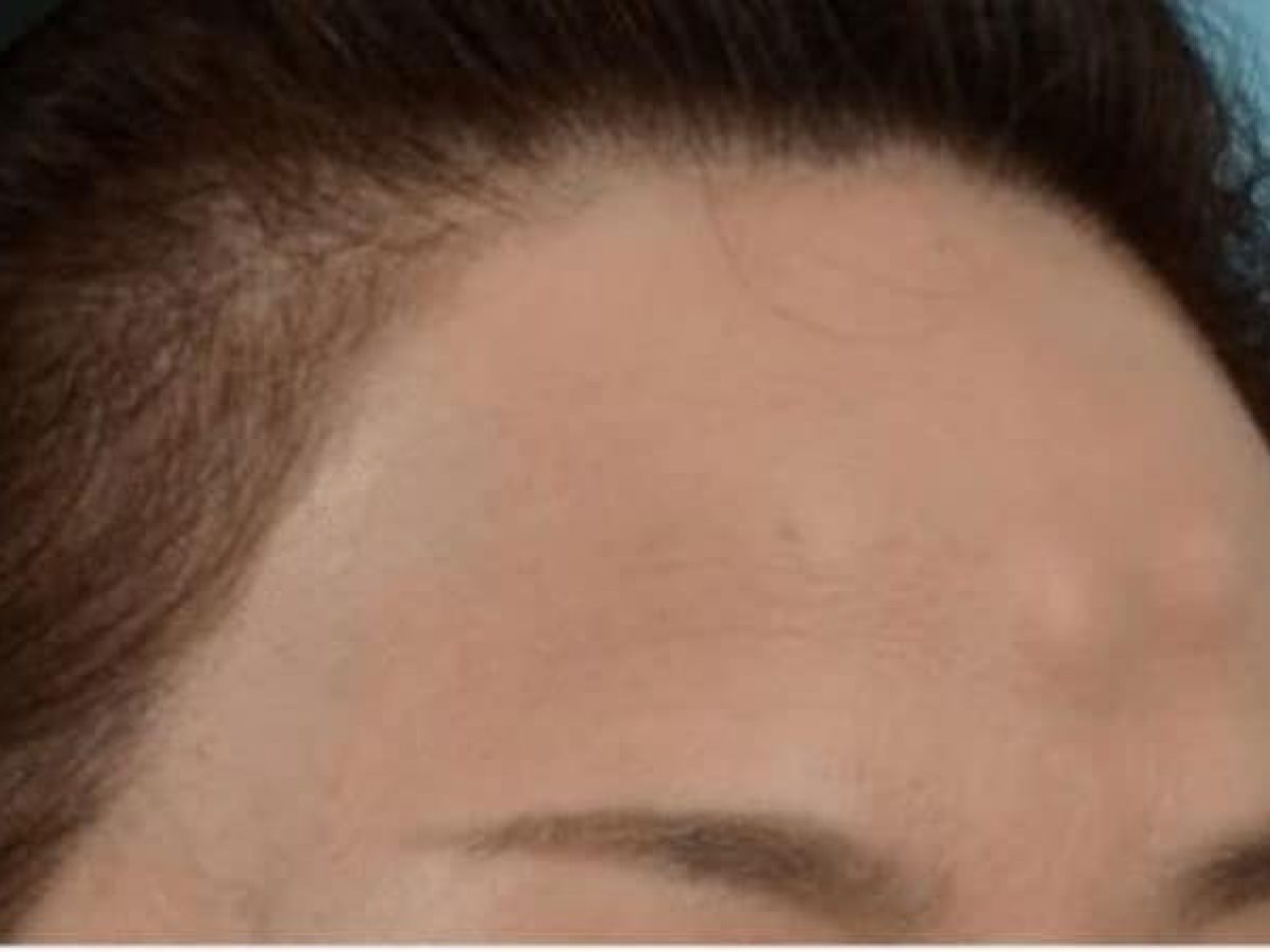 hard-cyst-on-forehead