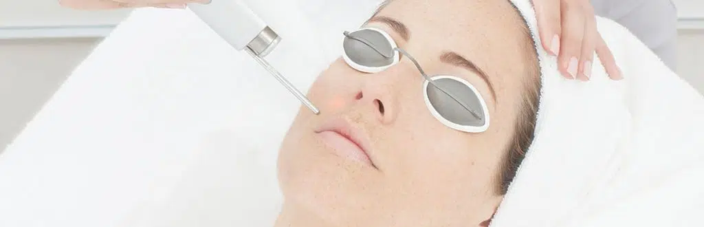 laser-acne-scar-removal