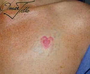 surgical tattoo removal before