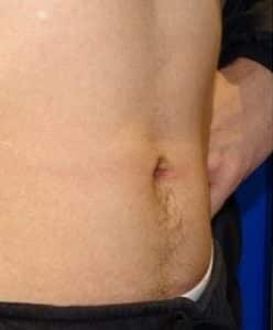 belly button surgery london