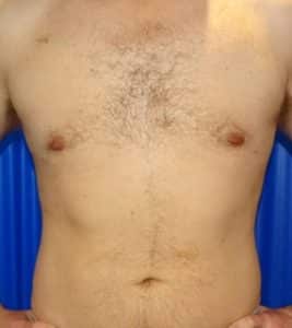 male breast reduction after