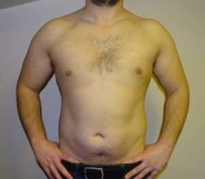 male breast reduction gynecomastia correction after