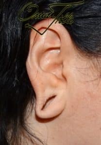 earlobe repair before