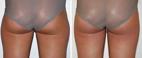 laser lipo before and after