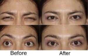 Anti Wrinkle Injections before and after