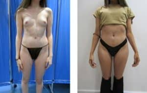 Power assisted liposuction