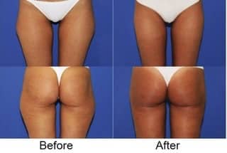 thigh liposuction results