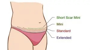 tummy tuck