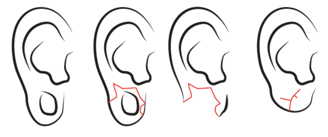 tribal earlobe repair