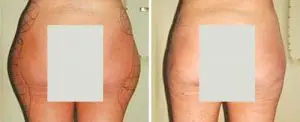 laser lipo local anaesthetic