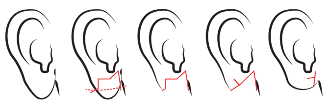 stretched earlobe repair