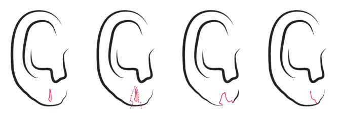 split earlobe repair