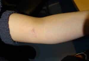 surgical tattoo removal arm before