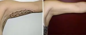 arm liposuction results