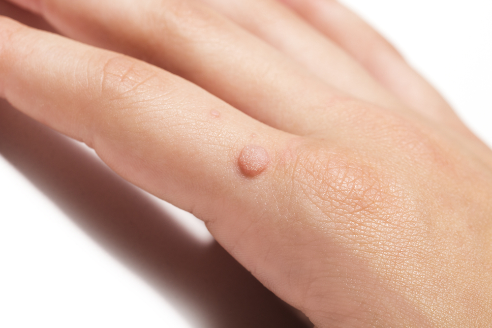 wart treatment london