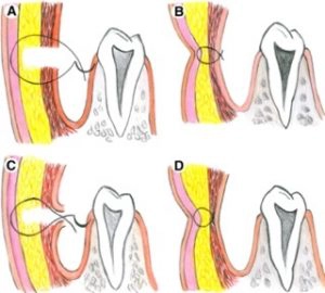 dimple creation surgery