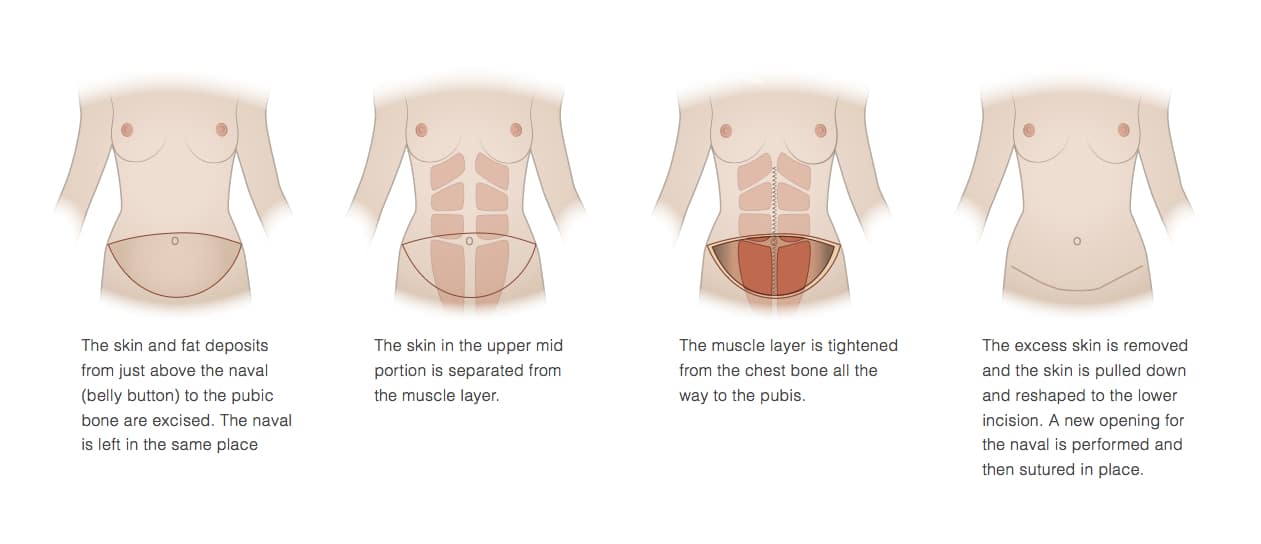 [Image: abdominoplasty-procedure.jpg]