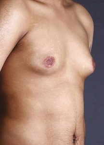 bodytite male breast reduction before