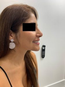 preservation rhinoplasty after side view