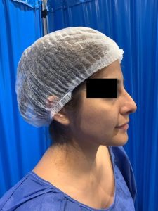 preservation rhinoplasty before side view