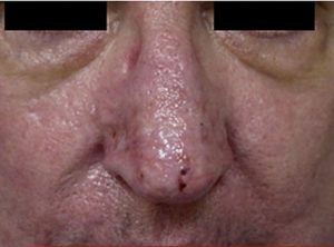 rhinophyma reduction after