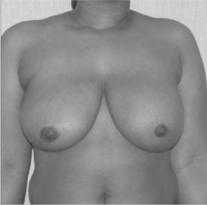 liposuction breast reduction after