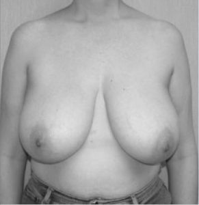 liposuction breast reduction before