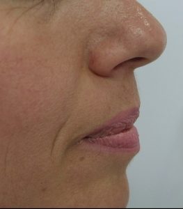 laser mole removal after