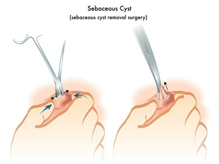 cyst removal surgical technique