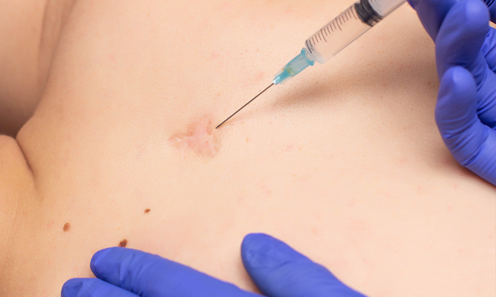 Steroid injection for scar revision