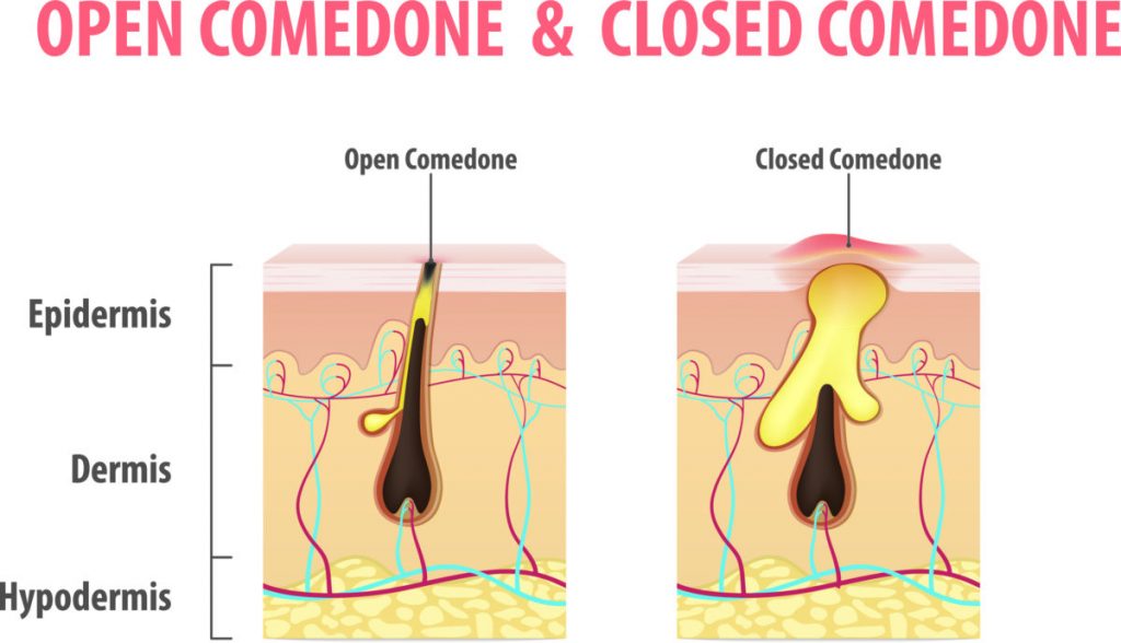 Types of comedone found in acne