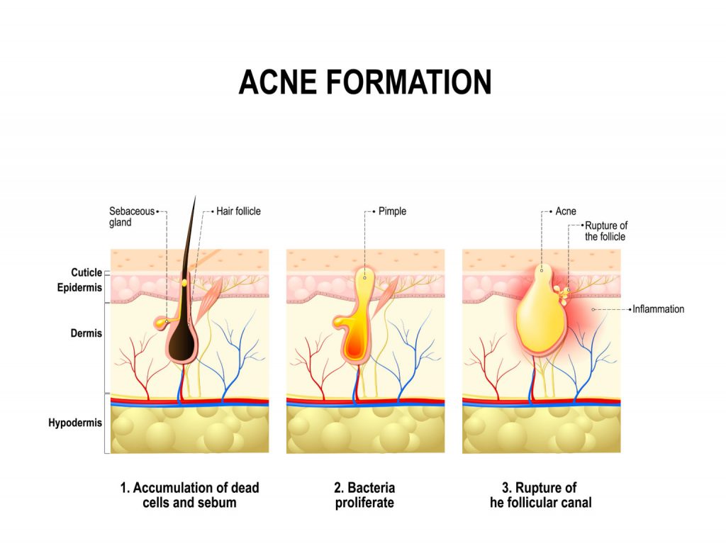acne formation