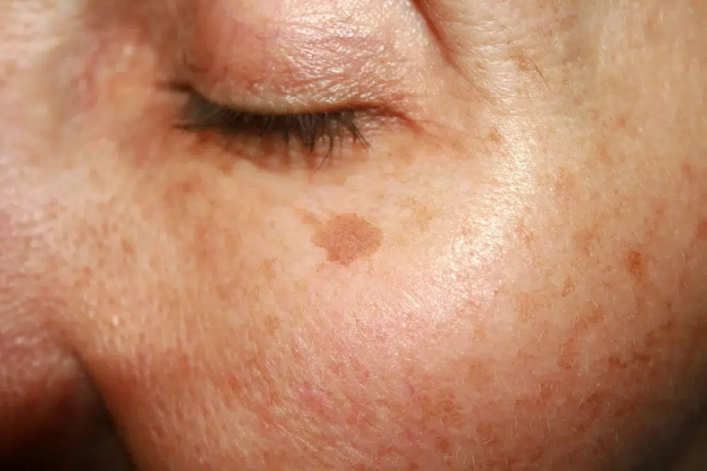 age spot removal london