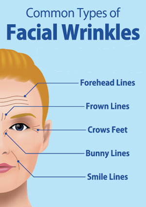 common types of facial wrinkles