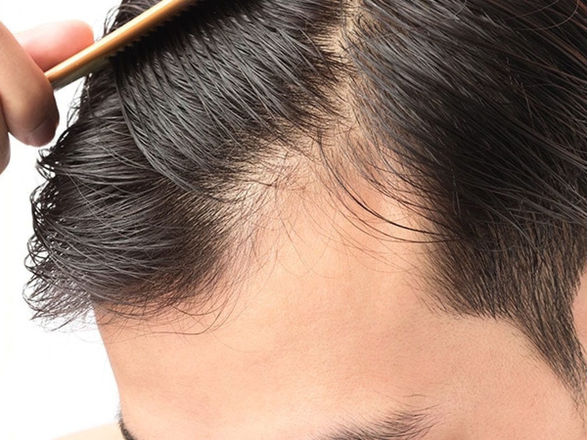 Hair Loss Medications | Thinning Hair & Baldness Treatment London UK Hair Loss Medications | Thinning Hair & Baldness Treatment London UK