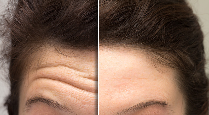 horizontal forehead lines Anti Wrinkle Injections