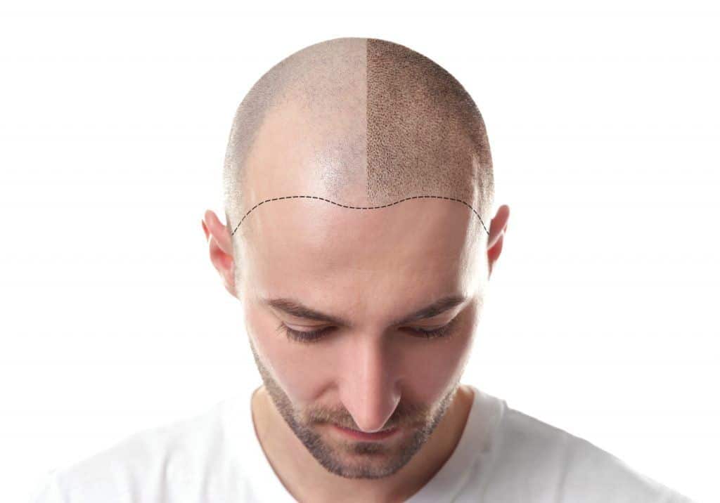 Scalp Micro Pigmentation