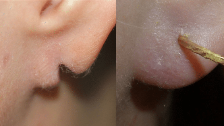 split earlobe repair 3