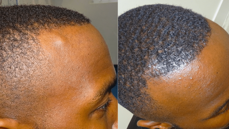 forehead osteoma removal before after 3