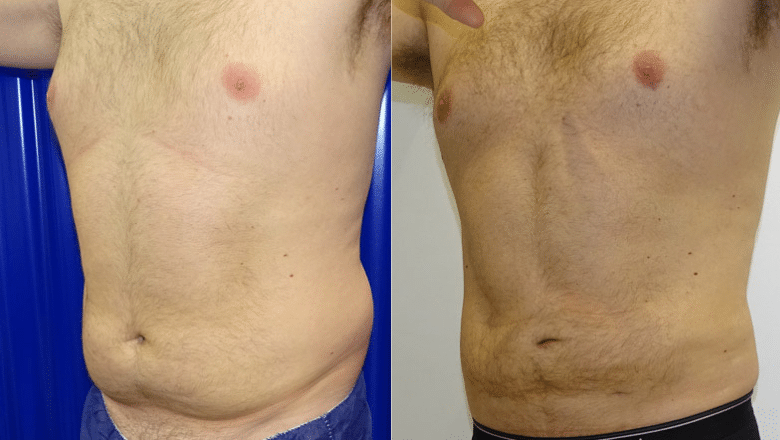 male belly liposuction before after