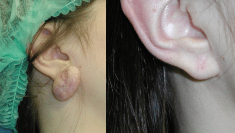 earlobe keloid removal before after 1