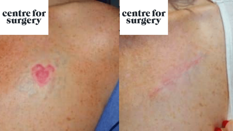 surgical tattoo removal chest before after