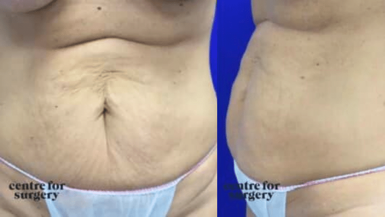 brazilian tummy tuck before photos