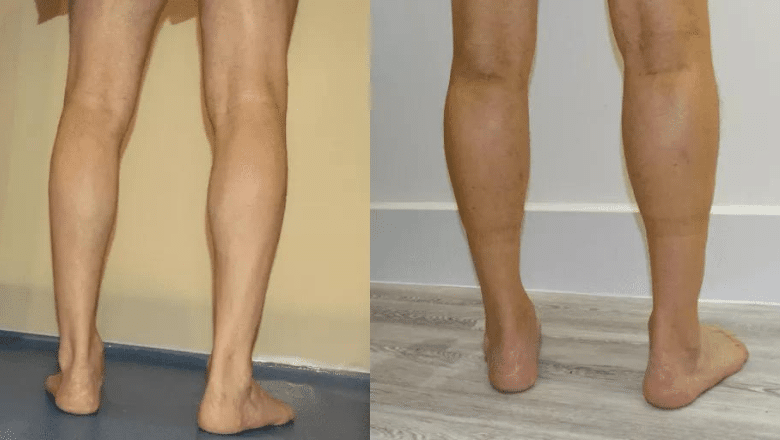 bilateral male calf augmentation before after